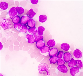 Neoplasia a cellule dendritiche plasmacitoidi blastiche BPDCN